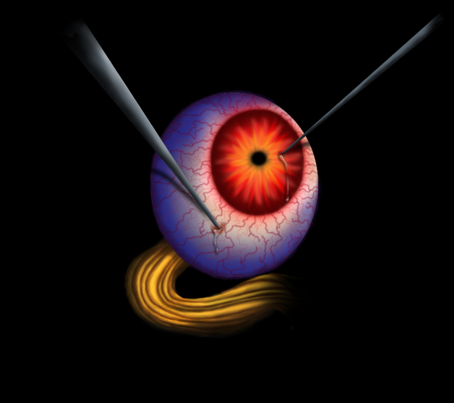dislodged eyeball probed with needles